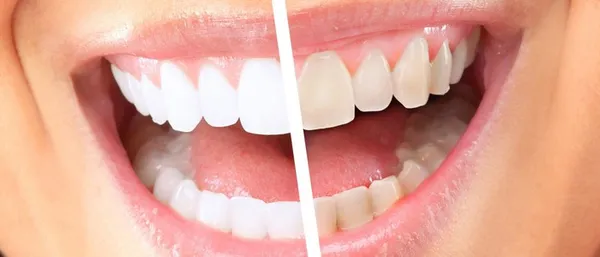 отбеливающие пластинки для зубов 